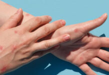 Primer caso de viruela símica en Escobar: un hombre de 38 años que evoluciona favorablemente en su domicilio