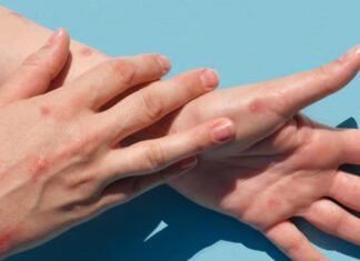 Primer caso de viruela símica en Escobar: un hombre de 38 años que evoluciona favorablemente en su domicilio