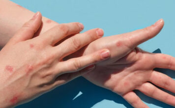 Primer caso de viruela símica en Escobar: un hombre de 38 años que evoluciona favorablemente en su domicilio