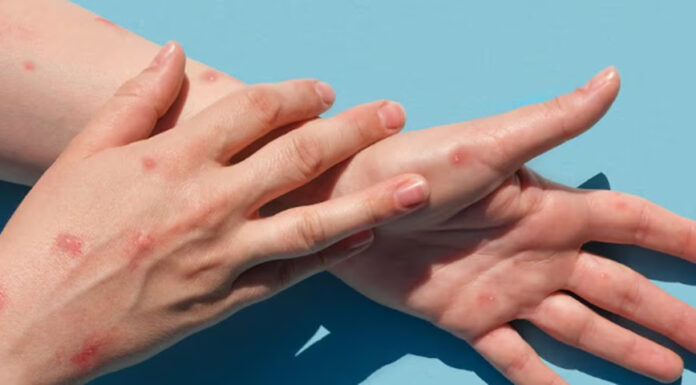 Primer caso de viruela símica en Escobar: un hombre de 38 años que evoluciona favorablemente en su domicilio